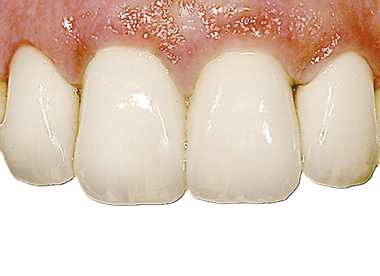 Shofu Vintage ZR Porcelain 15g